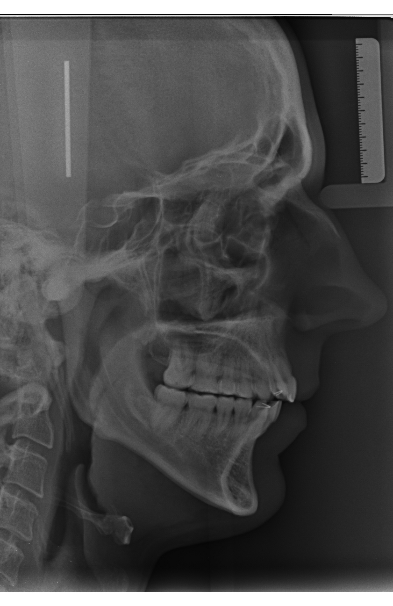 Telerradiografía lateral